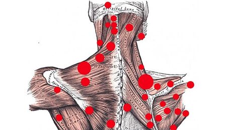 Triggerpoints in spieren die myofasciale rugpijn veroorzaken