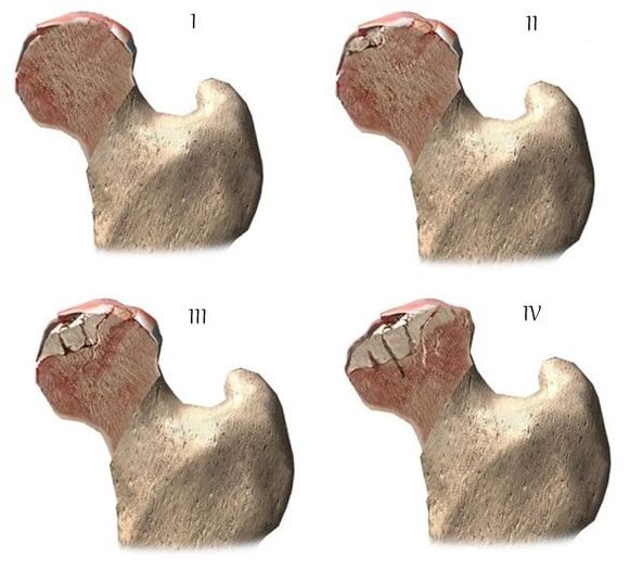 stadia van artrose van het heupgewricht