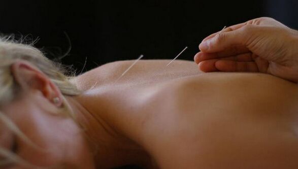 acupunctuur voor rugpijn