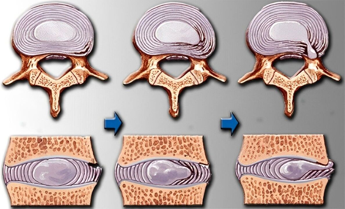 stadia van osteochondrose