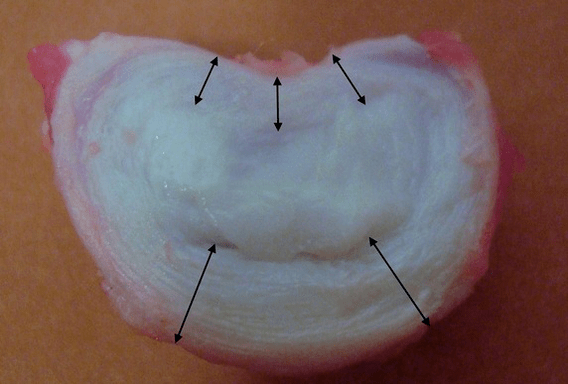 hoe ziet een tussenwervelschijf eruit
